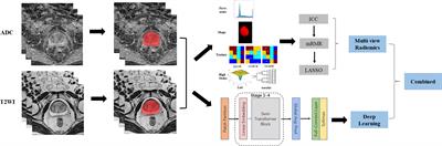 Multi-view radiomics and deep learning modeling for prostate cancer detection based on multi-parametric MRI